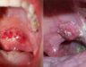 Ung thư vòm họng giai đoạn đầu có triệu chứng như thế nào?