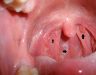 Ung thư vòm họng triệu chứng ban đầu thế nào? Cách điều trị bệnh