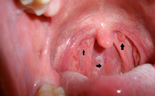 Ung thư vòm họng triệu chứng ban đầu như thế nào?