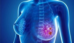 Ung thư vú là một trong những căn bệnh nguy hiểm thường gặp ở phụ nữ