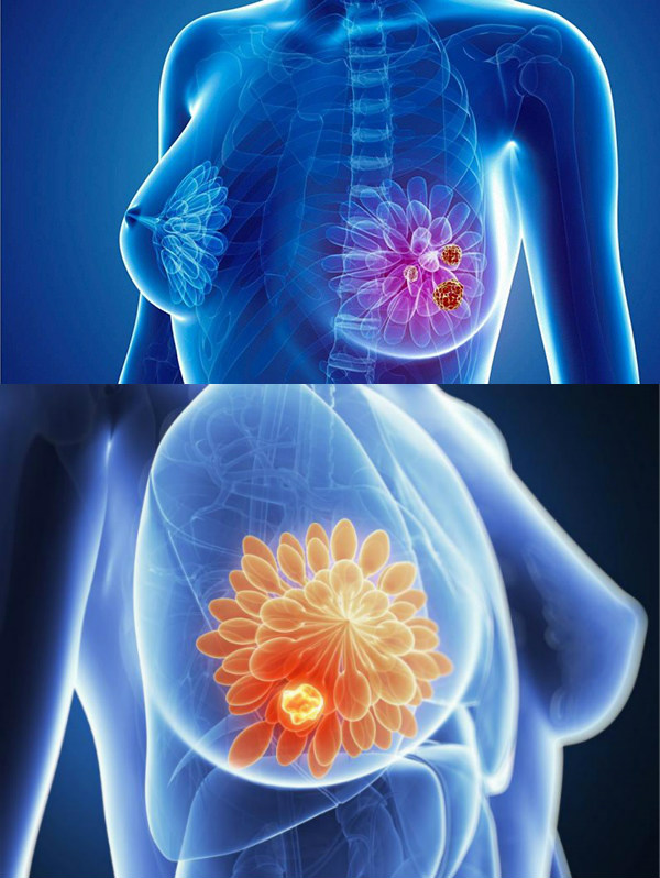 Ung thư vú là căn bệnh nguy hiểm ở nữ giới