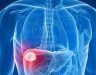Ung thư gan di căn lên phổi. Cách phòng ngừa ung thư gan hữu hiệu