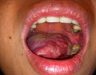 Ung thư lưỡi giai đoạn cuối có chữa được không? K lưỡi nên ăn gì?