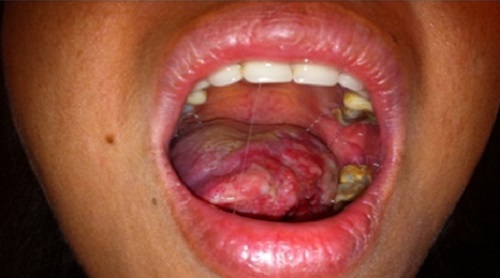 Biểu hiện bệnh ung thư lưỡi giai đoạn cuối