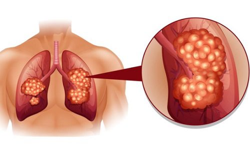 Hình ảnh ung thư màng phổi tiên phát