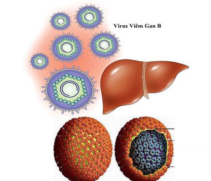 Viêm gan B do virus HBV gây nên
