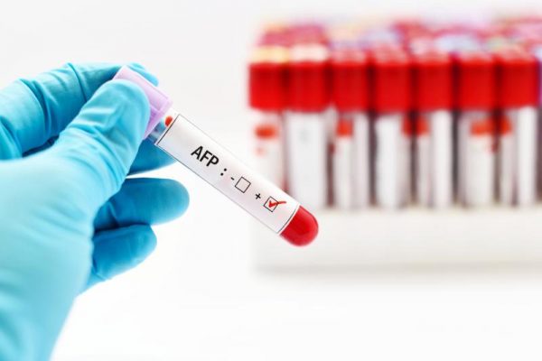 Xét nghiệm AFP giúp phát hiện bệnh ung thư gan hiệu quả