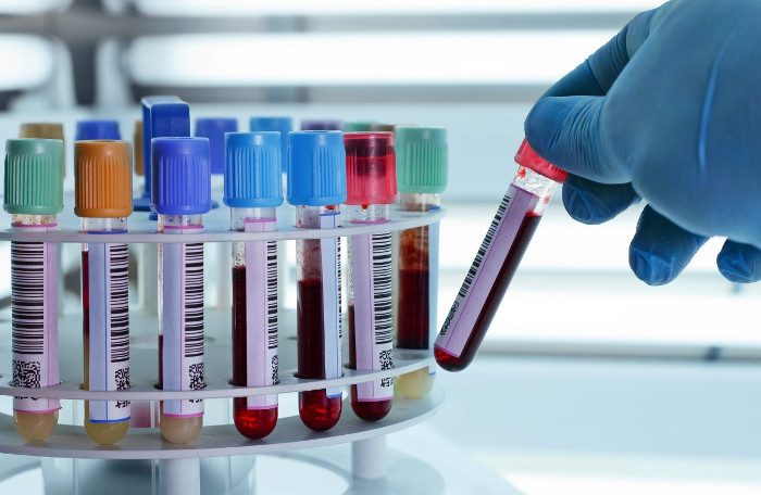 Xét nghiệm máu có thể phát hiện ung thư máu sớm