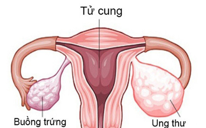Xét nghiệm ung thư buồng trứng ở đâu là thắc mắc của nhiều phụ nữ