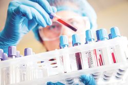 Xét nghiệm máu để chẩn đoán tế bào ung thư là xét nghiệm phổ biến hiện nay