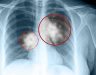 Hình ảnh X quang ung thư phổi được nhận biết như thế nào?