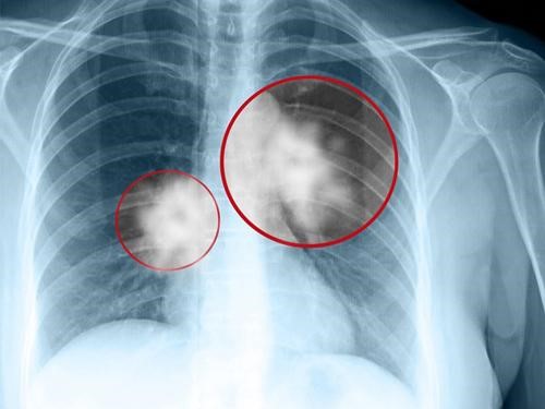 Hình ảnh x quang ung thư phổi