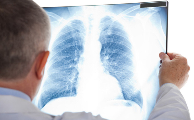 Chụp x quang có thể phát hiện được ung thư phổi