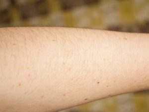 nốt ruồi trên cánh tay tỉ lệ với nguy cơ ung thư da