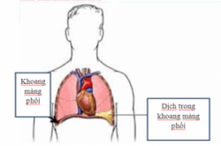 tràn dịch màng phổi