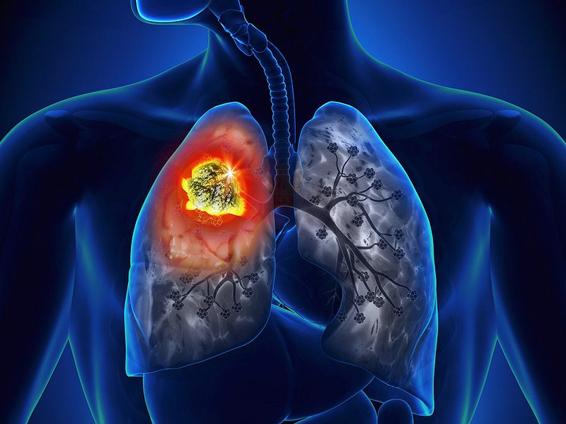 Ung thư biểu mô tế bào vảy của phổi