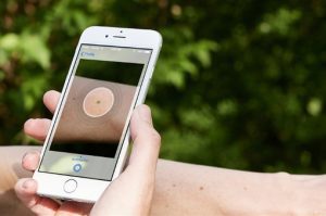 Ứng dụng SkinVision trên điện thoại sẽ giúp nhận biết ung thư da