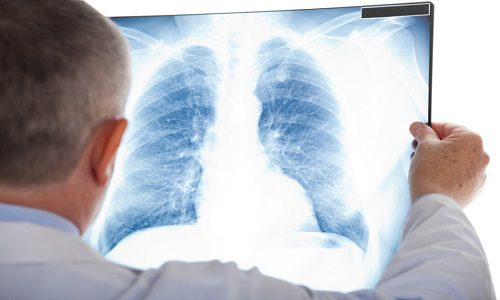 Phát hiện sớm ung thư phổi tăng cơ hội sống cho người bệnh