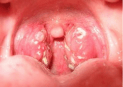 bệnh viêm họng hạt