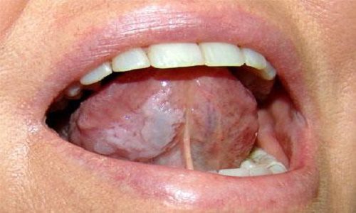 Cần biết cách phân biệt bệnh ung thư lưỡi và nhiệt miệng