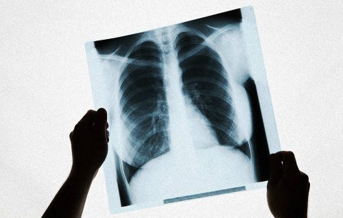 Câu hỏi trắc nghiệm kiểm tra nguy cơ mắc ung thư phổi