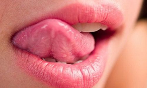 Đau khi chuyển động lưỡi có phải bị ung thư lưỡi?