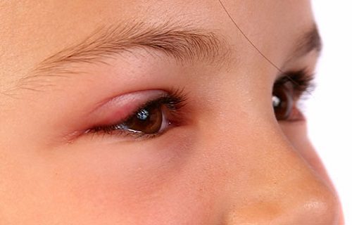 Bệnh ung thư mi mắt nếu được điều trị sớm sẽ có khả năng khỏi bệnh