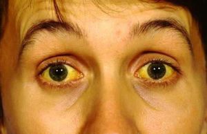 Vàng da, vàng mắt là một trong những dấu hiệu của bệnh viêm gan B