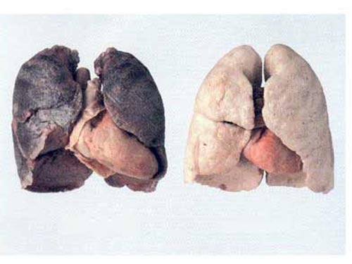 Nắm rõ nguyên nhân bệnh ung thư phổi nhằm phòng tránh bệnh tốt nhất