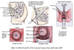 viêm lộ tuyến cổ tử cung