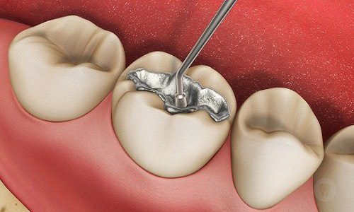 Thủy ngân có nhiều trong bạc kim loại hàn răng