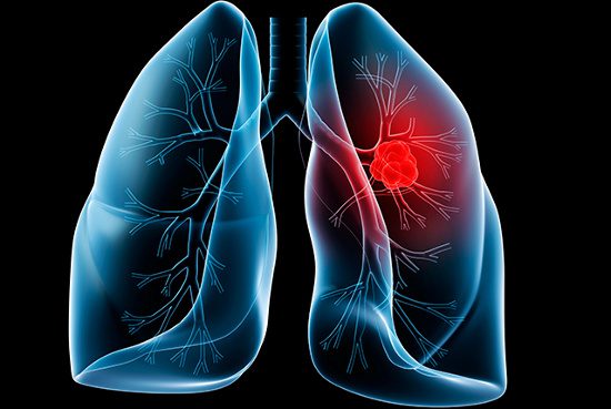 Dấu hiệu cảnh báo ung thư phổi