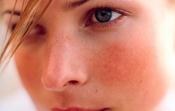 Chứng đỏ mặt cũng có thể là dấu hiệu của ung thư da