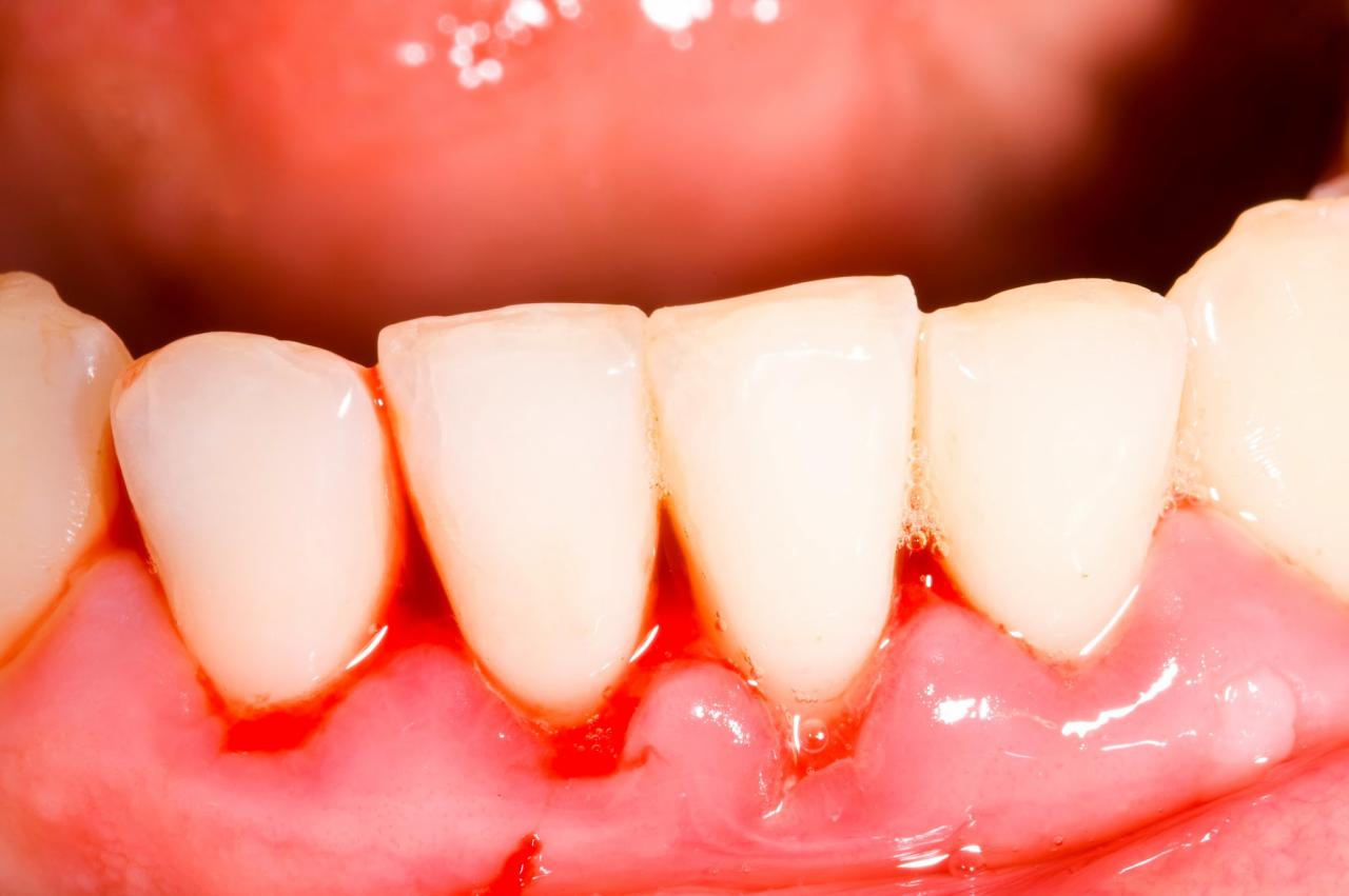 Người mắc bệnh ung thư máu thường xuyên bị chảy máu nướu răng