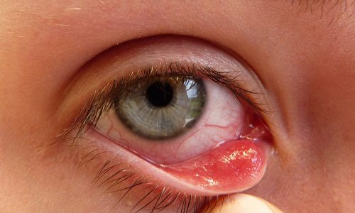 Xuất hiện nốt nhỏ trong mắt có thể là triệu chứng ung thư mắt