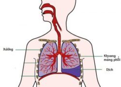 Phương pháp điều trị tràn dịch màng phổi