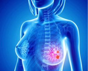 Ung thư vú – căn bệnh nguy hiểm của phụ nữ