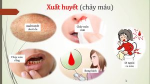 Triệu chứng sốt xuất huyết ở trẻ