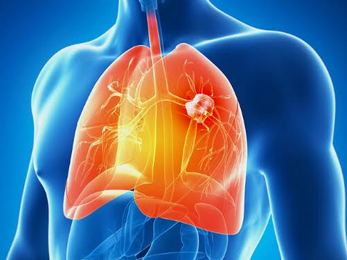 Nguyên nhân mắc ung thư phổi do ăn nhiều chất bột đường