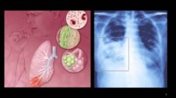 Viêm phổi cấp là một dạng viêm phổi nặng gây ra bởi vi khuẩn Legionella