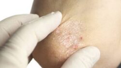 Giữa ẩm cho da là phương pháp xử lý đơn giản nhất khi bị ngứa do bệnh vảy nến