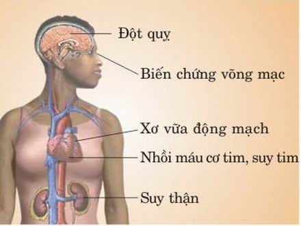 biến chứng của bệnh cao huyết áp