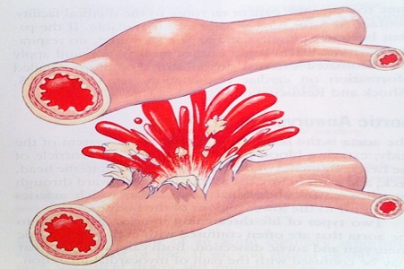 biến chứng của xơ gan