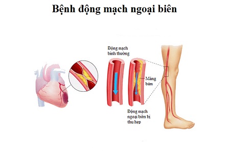 Các bệnh lý tim mạch thường gặp