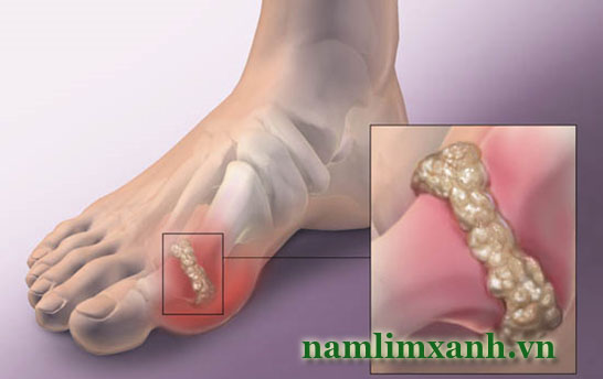 Bệnh gout gây ra những triệu chứng nguy hiểm