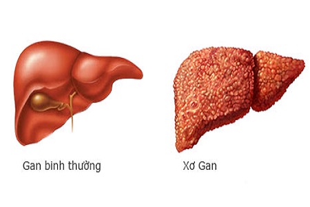 xơ gan nên uống thuốc gì